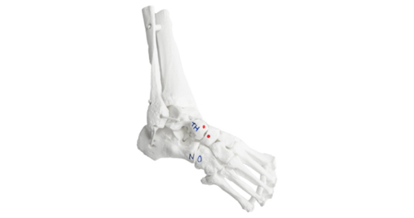 Ponseti Clubfoot Model